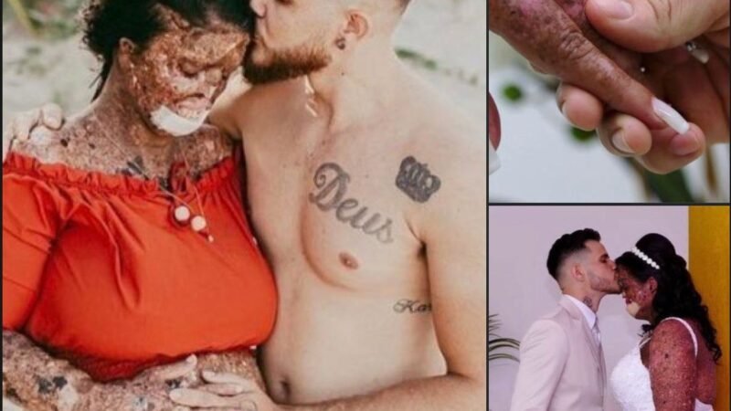 Woman with rare skin condition overcomes negativity and finds true love